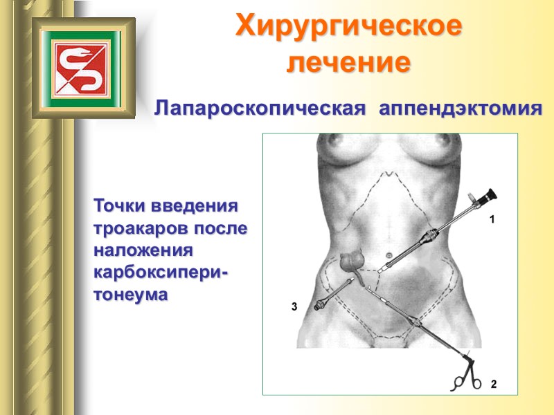 Хирургическое  лечение  Лапароскопическая  аппендэктомия Точки введения троакаров после наложения карбоксипери-тонеума